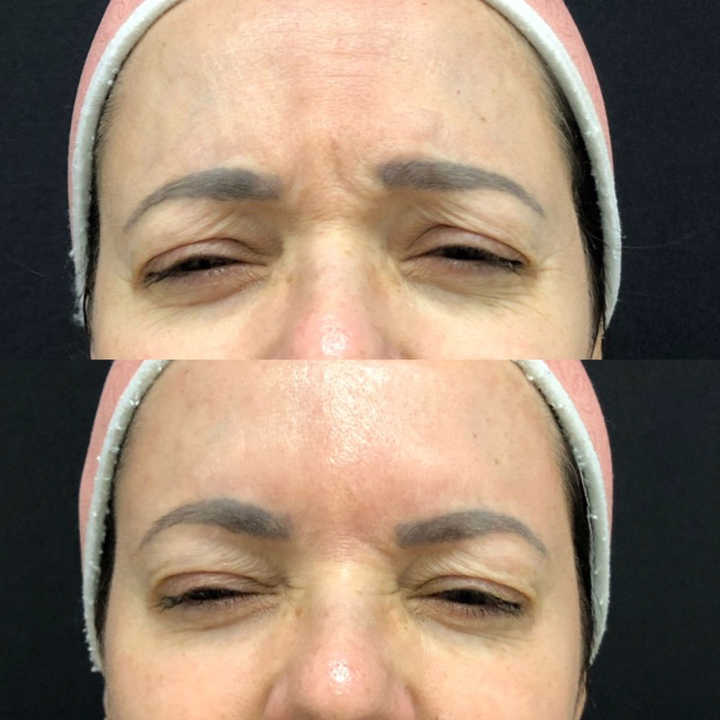 Antes e depois de botox na testa