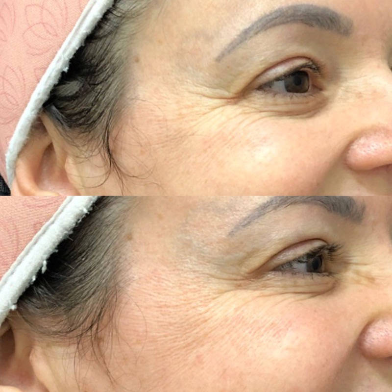 Antes e depois de botox