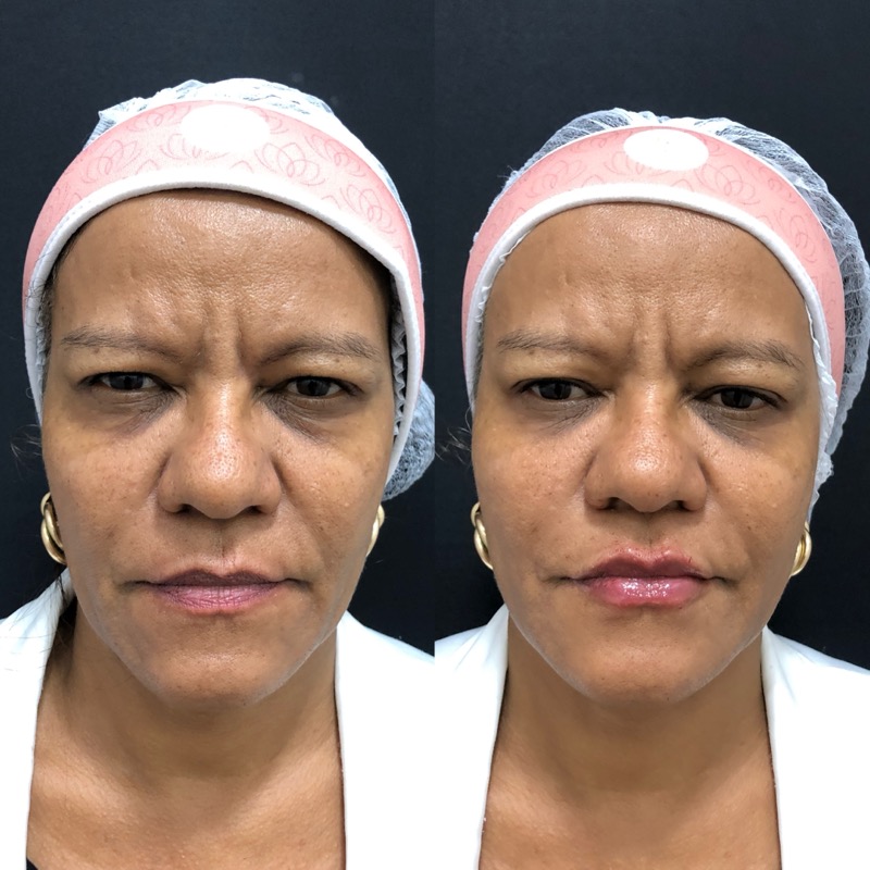 Resultado antes e depois de harmoniza&ccedil;&atilde;o facial completa